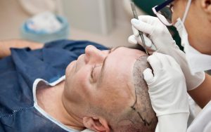 a-man-having-a-hair-transplant-and-hopefully-it-will-work